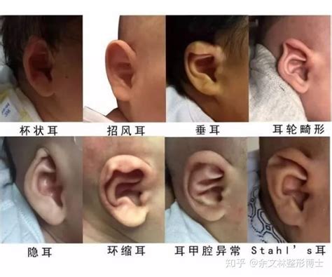 男人耳朵形状与命运图解_耳朵形状与命运图解耳轮突出,第24张